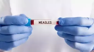 Measles Outbreak Spreads as 2 More US States Confirm New Cases